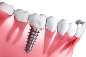 Diagram of dental implants in Ontario after placement