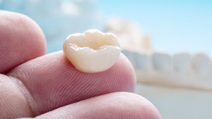 There are a number of factors that go into determining the cost of a dental crown treatment