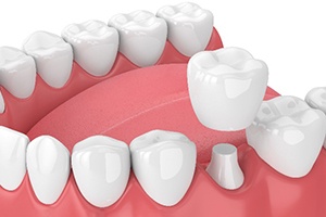 Illustration of dental crown being placed on bottom molar