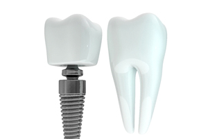 Comparison of model tooth and dental implant in Ontario