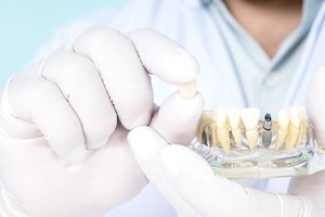 Ontario implant dentist holding restoration and model implants