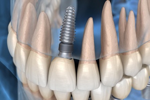 X-ray diagram showing how dental implants in Ontario work