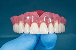 A digital image of veneers being placed over the two upper front teeth in M5R 3K4