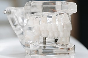 Plastic model for dental implants in Ontario