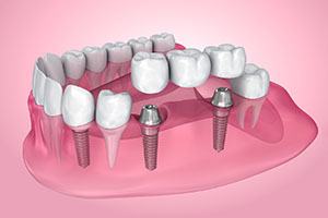 A 3D illustration of a dental bridge