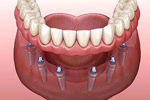 A 3D illustration of an implant denture