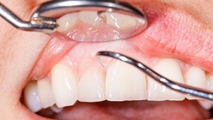 Close up of a dental cleaning. 