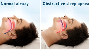 Image showing obstructive sleep apnea airway.