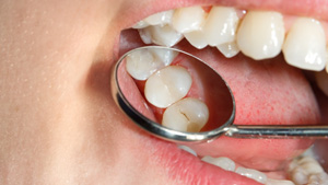 A close-up of a tooth-colored filling blending with natural enamel