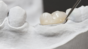 An illustration of a dental crown being placed over a damaged tooth in Toronto