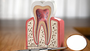 A model showing root canal treatment on an infected tooth