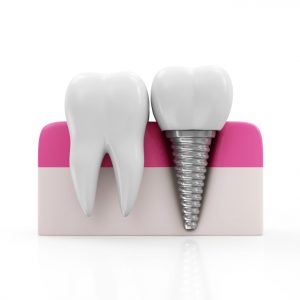 Dental implants can save your oral health.