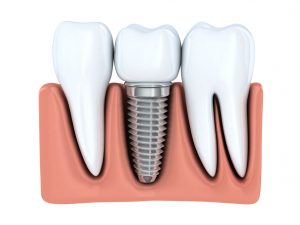 When thinking about replacing your missing teeth, you should consider the gold-standard upgrade: dental implants in M5R 3K4. 