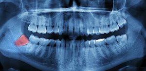 highlighted wisdom tooth