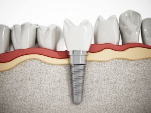 diagram dental implants