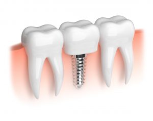 A diagram of a dental implant.