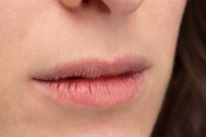 woman suffering from winter mouth issues